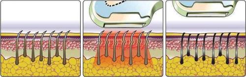 Результат после лазерной эпиляции бикини. Особенности удаления волос в интимной зоне