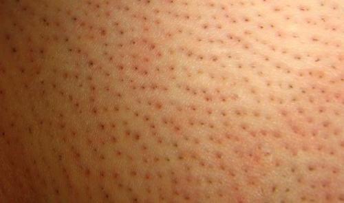 Ответы на вопросы по лазерной эпиляции. Как работает лазерная эпиляция? 12