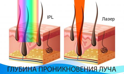 Лазерная эпиляция вред. Лазерная эпиляция на дому