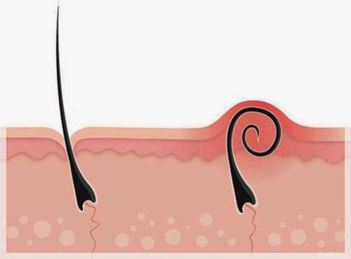 Как избавиться от вросших волос в зоне бикини после шугаринга. Вросшие волосы в паху