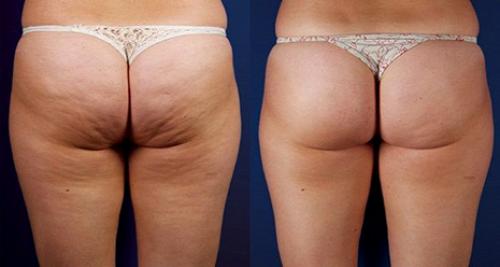 Показания и противопоказания к проведению LPG массажа. Техника проведения LPG-массажа 03