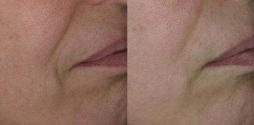 Lpg массаж лица до и после. LPG-лифтинг лица