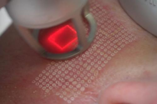 Биоревитализация или плазмолифтинг форум. Сочетание с другими процедурами