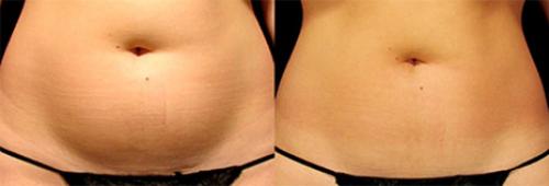 Lpg массаж показания и противопоказания. Противопоказания для проведения процедуры 04 Lpg массаж показания и противопоказания. Противопоказания для проведения процедуры 04