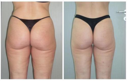 Что лучше кавитация или вакуумно-роликовый массаж. Процедура ультразвуковой кавитации 04