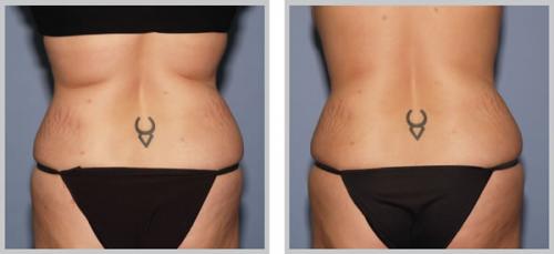 Что лучше кавитация или вакуумно-роликовый массаж. Процедура ультразвуковой кавитации 02