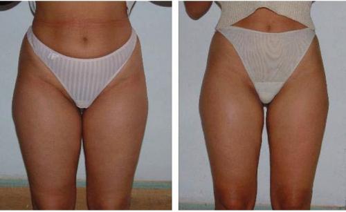 Что лучше кавитация или вакуумно-роликовый массаж. Процедура ультразвуковой кавитации 01