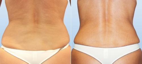 Что лучше кавитация или вакуумно-роликовый массаж. Процедура ультразвуковой кавитации 03