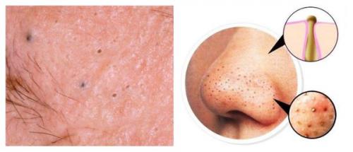 Как убрать красные пятна после прыщей на лице. Симптомы постакне 03