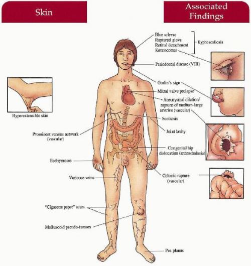 СИНДРОМ ГИПЕРМОБИЛЬНОСТИ суставов в общей практике. Гипермобильность суставов – это болезнь? 02 СИНДРОМ ГИПЕРМОБИЛЬНОСТИ суставов в общей практике. Гипермобильность суставов – это болезнь? 02