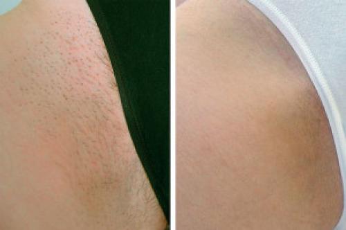 Как правильно удалять волосы в зоне бикини. Способы эпиляции бикини на дому