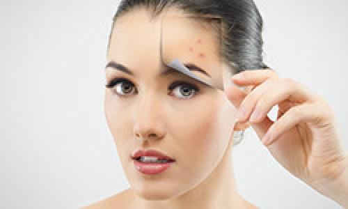 Какие таблетки пить от прыщей на лице. Чистая кожа раз и навсегда! Как победить акне?