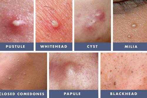 Как избавиться от следов после прыщей. Как убрать постакне? 04