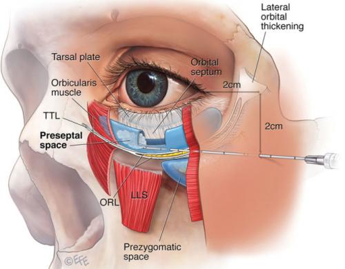 Уколы под глаза от темных кругов. Как убрать круги филлерами.