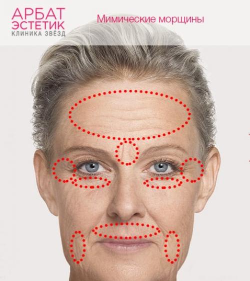 Сколько единиц ботокса нужно на гусиные лапки. В каких случаях ботокс для зоны вокруг глаз эффективен? 02