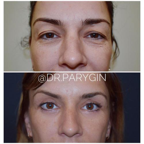 Коррекция гусиных лапок. Американская блефаропластика Фраксель 01