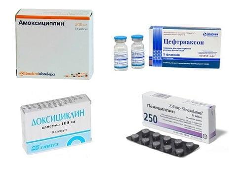 Препараты для лечения суставов. Антибактериальная терапия при септических артритах