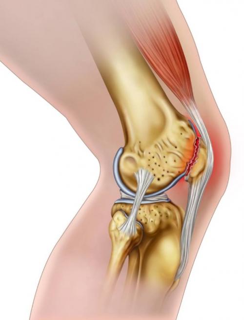 Лечение хряща коленного сустава. Немедикаментозные методы 02 Лечение хряща коленного сустава. Немедикаментозные методы 02