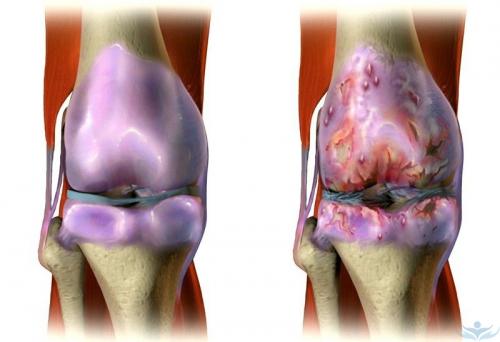 Артроз коленного сустава лечение в домашних условиях. Артроз коленных суставов или гонартроз