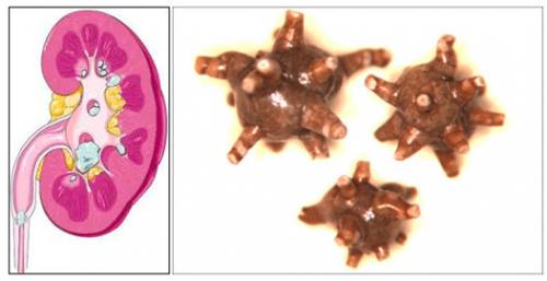 Как правильно питаться при оксалатных камнях в почках 01 Как правильно питаться при оксалатных камнях в почках 01