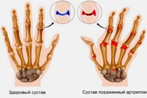 Лечение артрита рук в домашних условиях. Лечение артрита пальцев рук дома — обзор эффективных методик