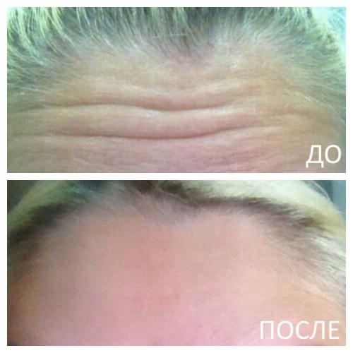 Сколько нужно единиц ботокса. Как действует Ботокс после введения? 01