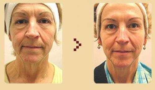 Вакуумный массаж лица до и после. Вакуумный массаж лица (отзывы, фото, результаты)