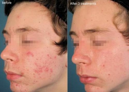 Вакуумный массаж лица до и после. Вакуумный массаж лица (отзывы, фото, результаты)