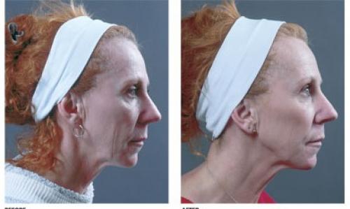 Вакуумный массаж лица до и после. Вакуумный массаж лица (отзывы, фото, результаты)