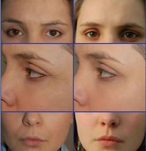 Вакуумный массаж лица до и после. Вакуумный массаж лица (отзывы, фото, результаты)