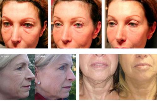 Вакуумный массаж лица до и после. Вакуумный массаж лица (отзывы, фото, результаты)