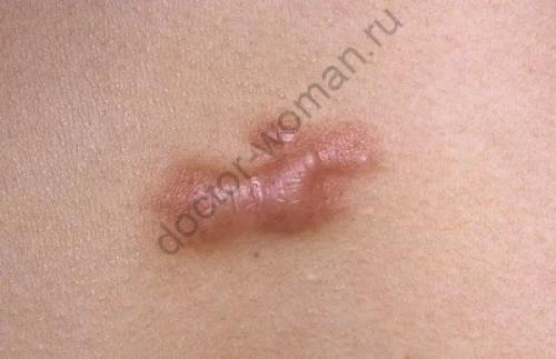 Какие результаты можно ожидать после устранения темных пятен от прыщей. Какие бывают следы от прыщей