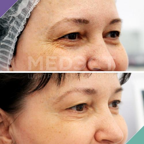 Разгладить морщины под глазами самый действенный метод. Все способы избавиться от морщин вокруг глаз