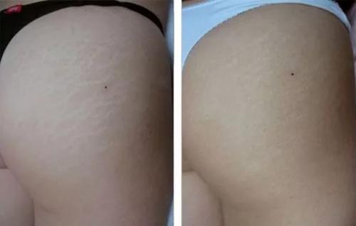 Старвак екатеринбург. Вакуумный массаж Старвак (Starvac)