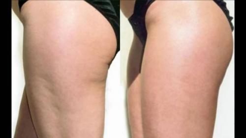 Старвак екатеринбург. Вакуумный массаж Старвак (Starvac)