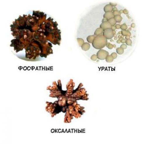 Противокаменная диета: как избежать образования камней в почках 02 Противокаменная диета: как избежать образования камней в почках 02