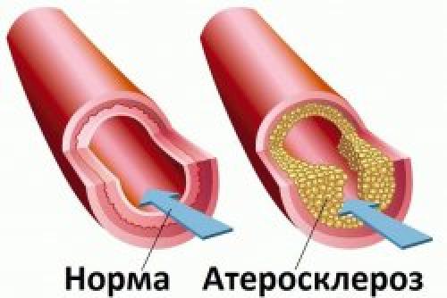 Какие вещества в масле способствуют здоровью сосудов. Зачем нужно проводить чистку?