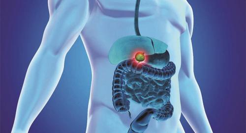 Сколько времени может занять операция по удалению желчного пузыря. Показания к холецистэктомии