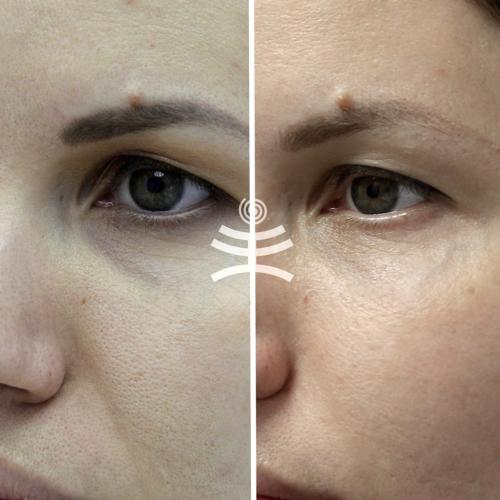 Чем убрать морщины под глазами. Все способы избавиться от морщин вокруг глаз