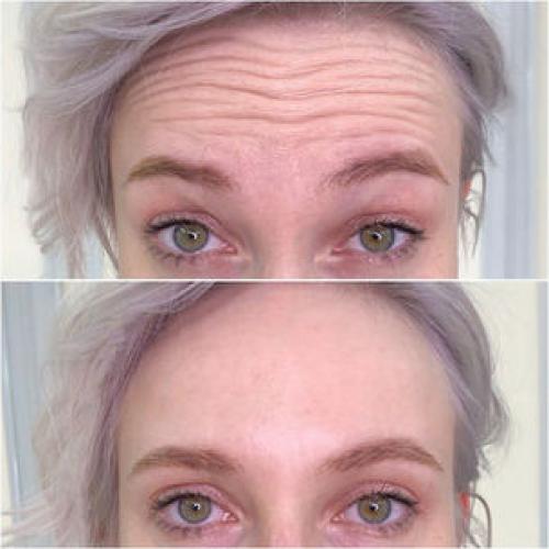 Улучшай свой внешний вид: ботокс для лба и межбровья до и после 03