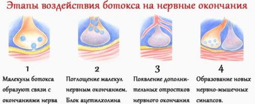 Ботокс для лба и межбровья до и после. Как действуют уколы Ботокса на лобные морщины