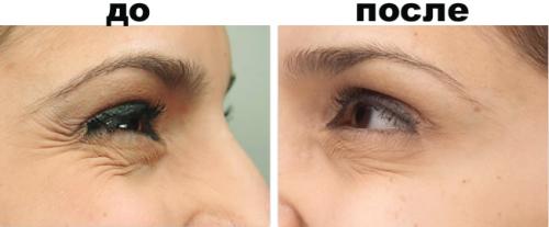 Что такое гусиные лапки под глазами. Как убрать гусиные лапки вокруг глаз