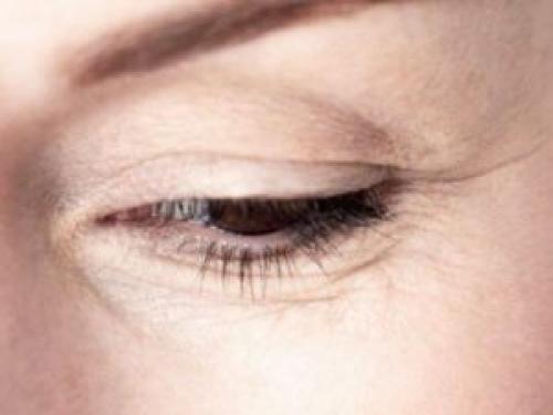 Что такое гусиные лапки. Почему они появляются?