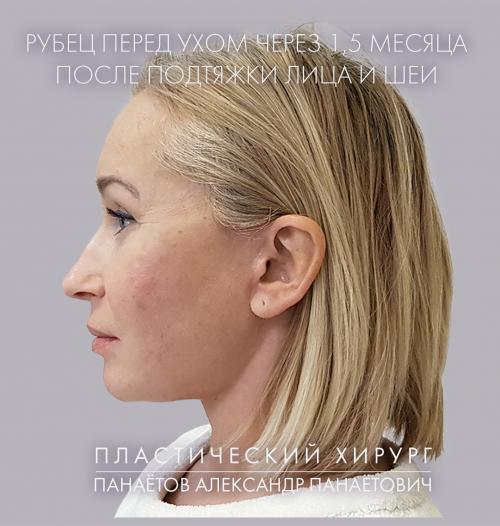 Как избежать образования рубцов после удаления усов. Послеоперационные шрамы и рубцы: как их избежать?