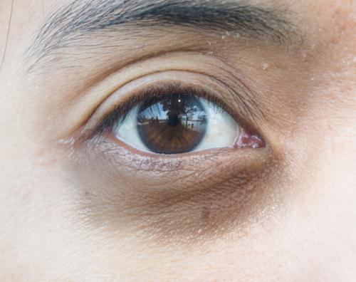 Тонкая кожа под глазами. Давайте взглянем на анатомическое строение области глаз.