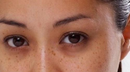 Тонкая кожа под глазами. Давайте взглянем на анатомическое строение области глаз. 13