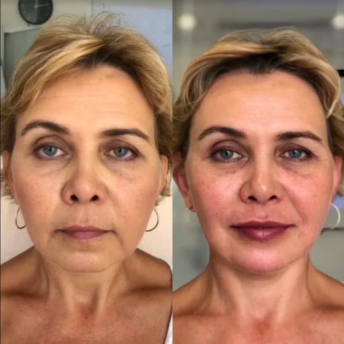 Самые эффективные косметические процедуры для лица 2021. SMAS лифтинг лица 