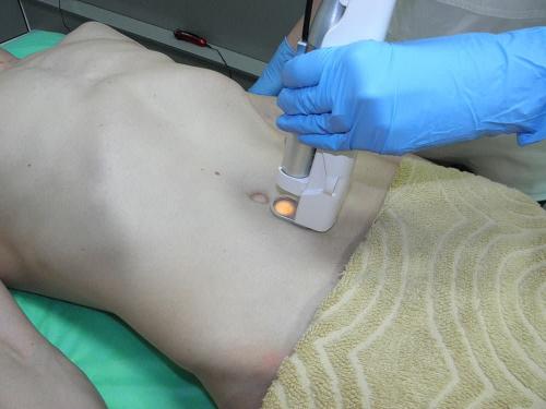 Не выпадают волосы после лазерной эпиляции. В чем отличие эпиляции и депиляции? Кому, что подходит? И что эффективнее? 10