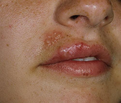 Как убрать следы от прыщей на попе. Герпес на ягодицах