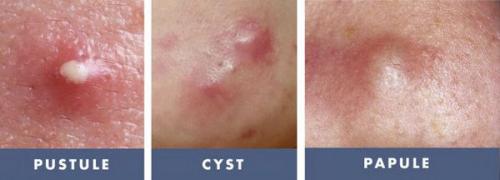 Как убрать следы от прыщей на попе. Герпес на ягодицах 04 Как убрать следы от прыщей на попе. Герпес на ягодицах 04